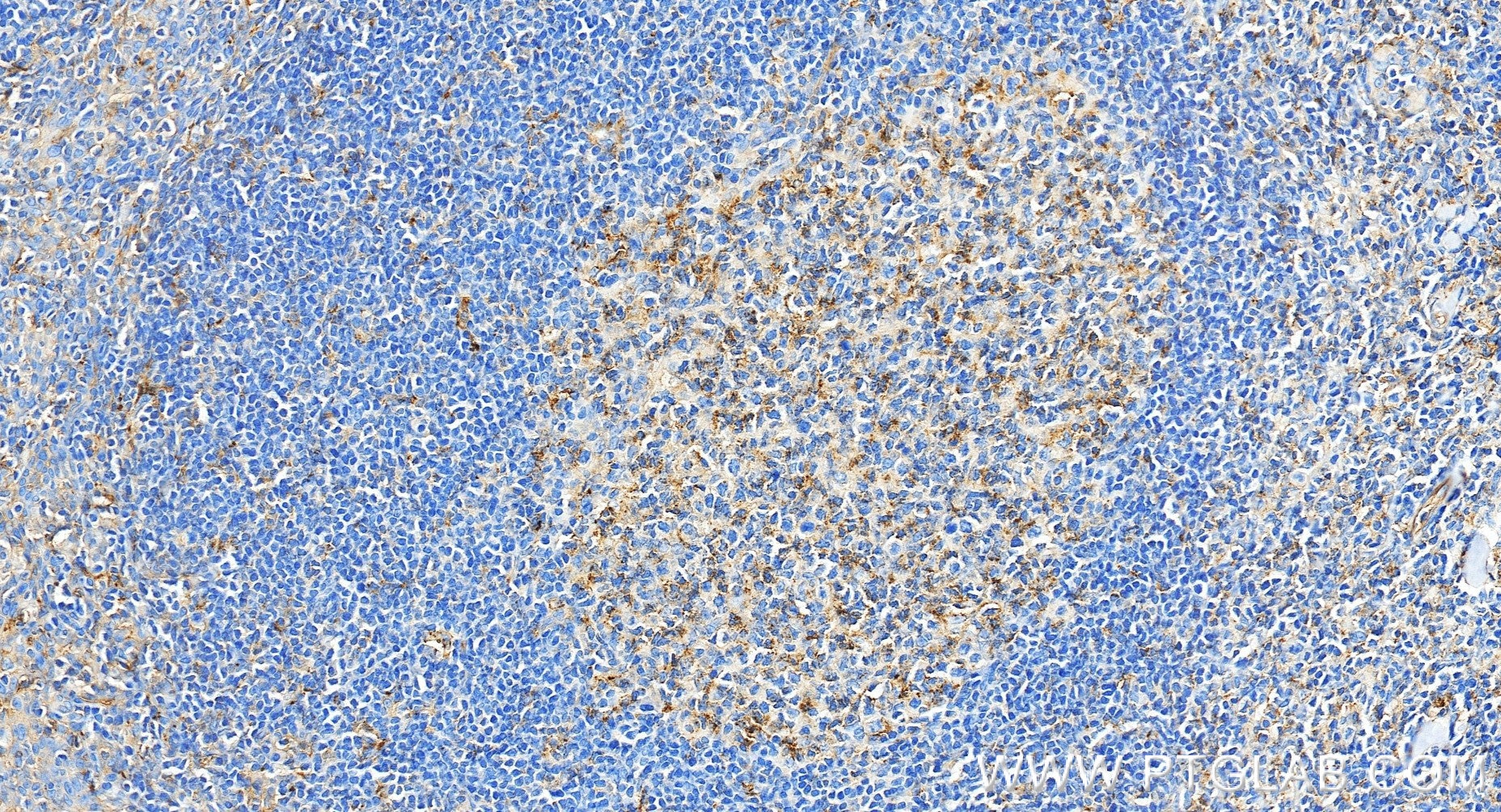 Immunohistochemistry (IHC) staining of human tonsillitis tissue using CD58 Recombinant monoclonal antibody (85950-1-RR)