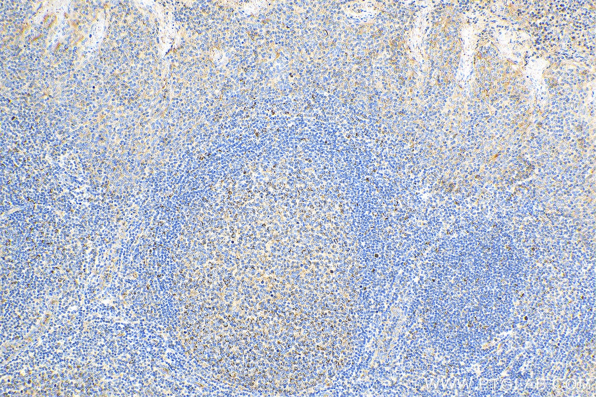 IHC staining of human tonsillitis using 10742-1-AP