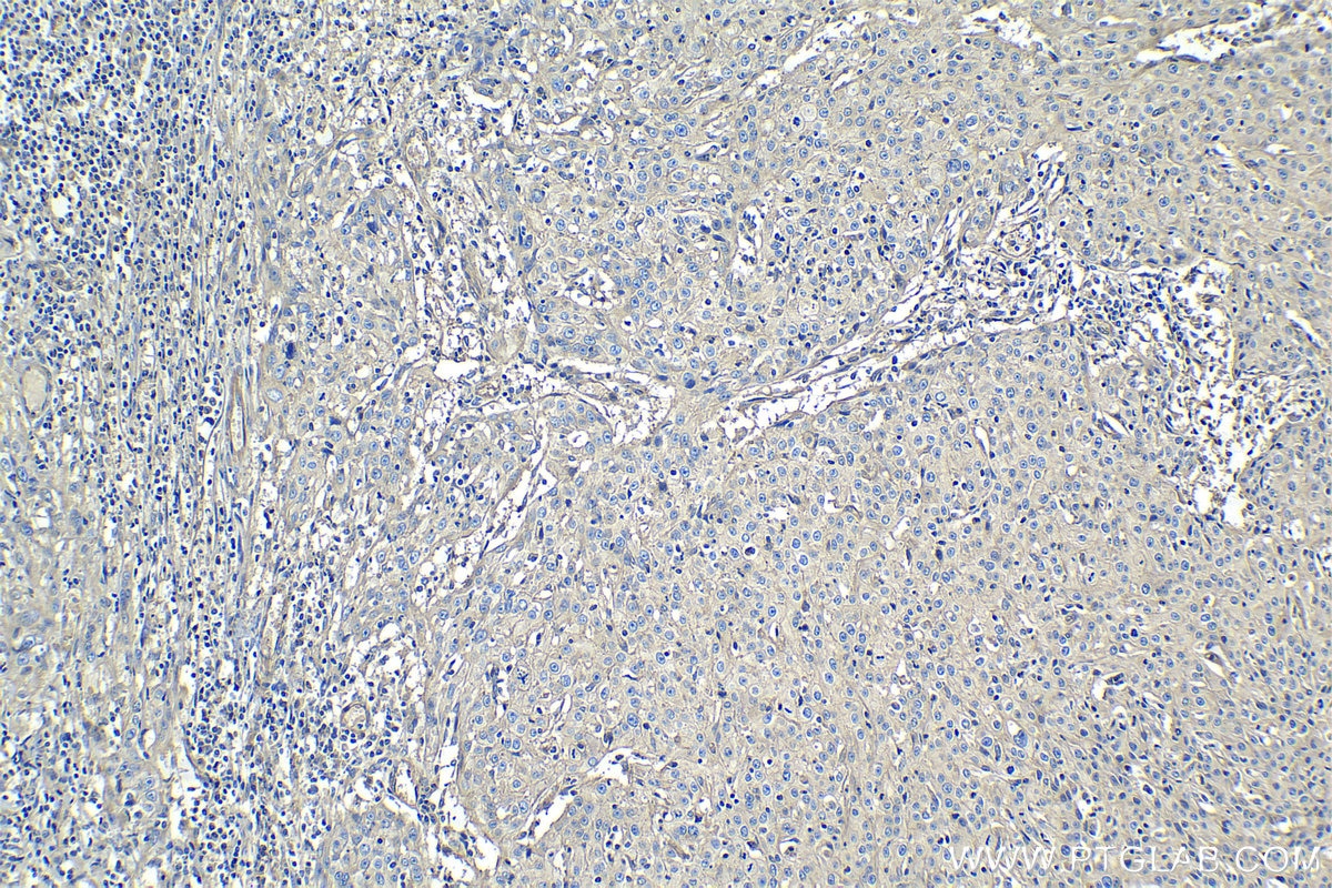 Immunohistochemistry (IHC) staining of human cervical cancer tissue using CD59 Monoclonal antibody (68222-1-Ig)