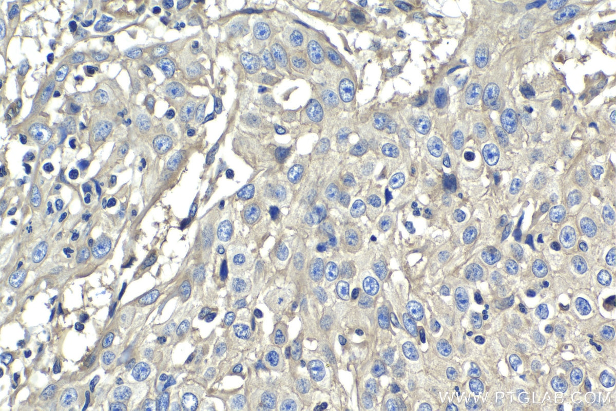 Immunohistochemistry (IHC) staining of human cervical cancer tissue using CD59 Monoclonal antibody (68222-1-Ig)