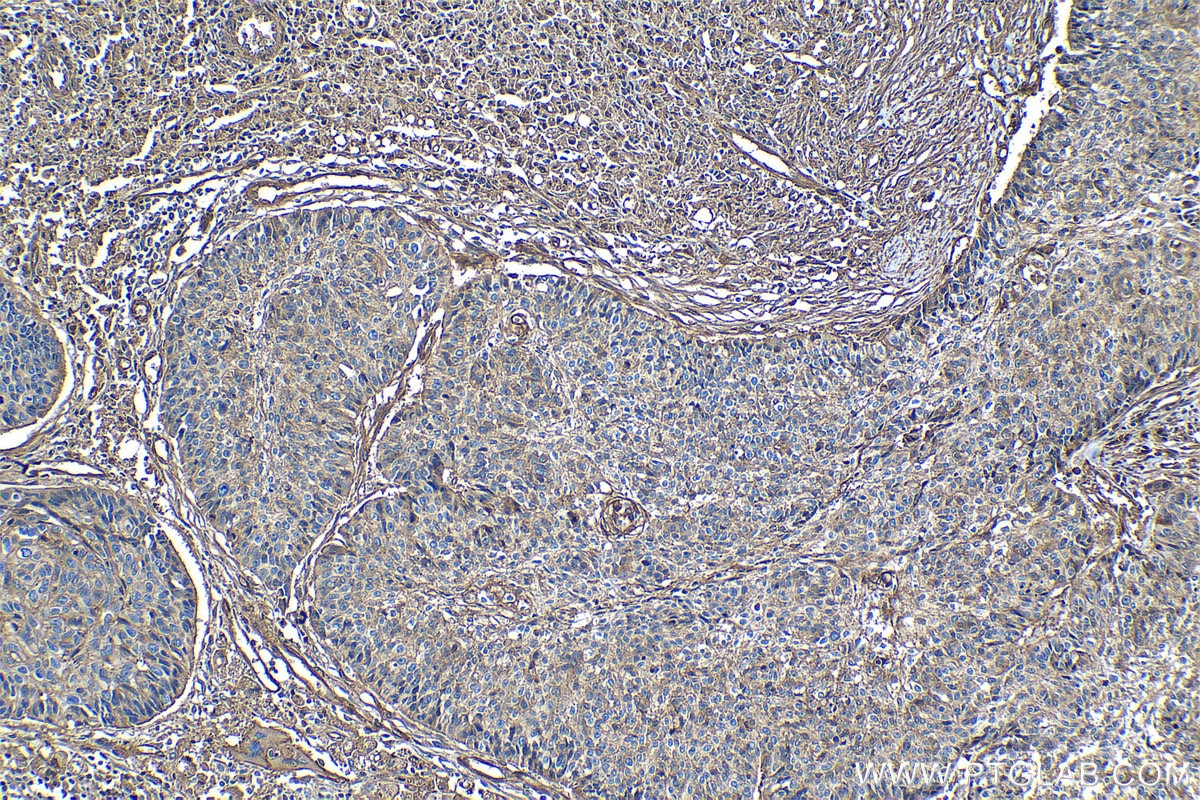 Immunohistochemistry (IHC) staining of human lung cancer tissue using CD59 Monoclonal antibody (68222-1-Ig)