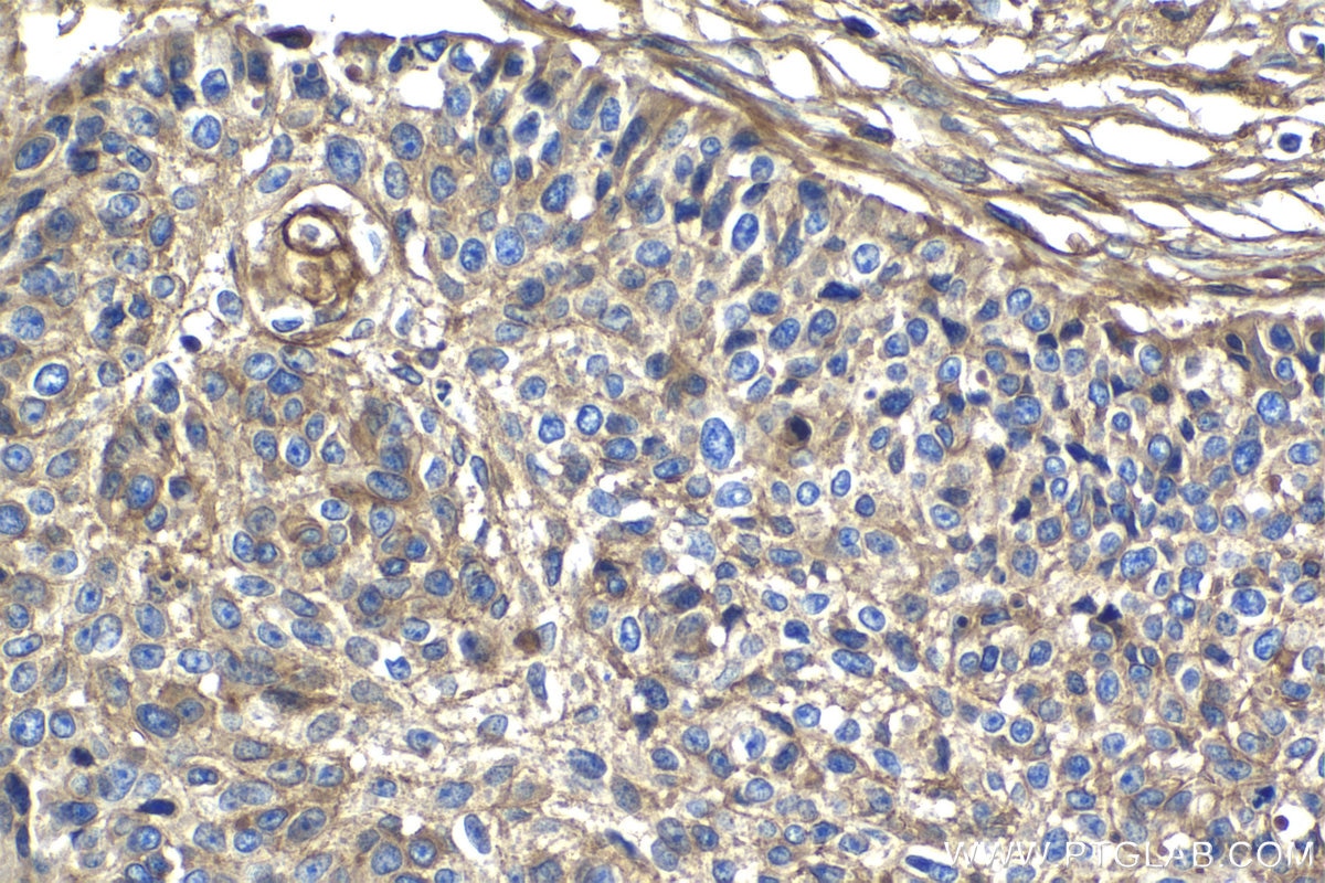Immunohistochemistry (IHC) staining of human lung cancer tissue using CD59 Monoclonal antibody (68222-1-Ig)