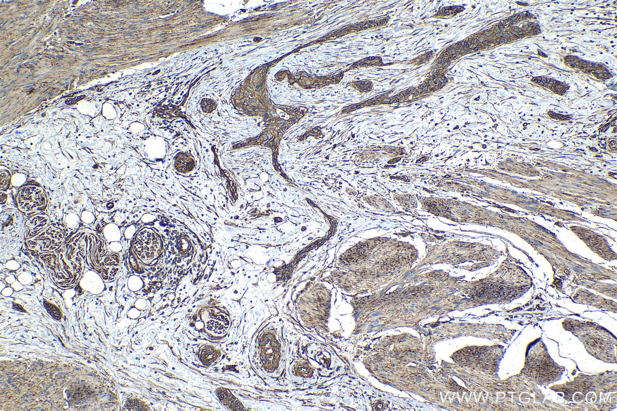 IHC staining of human urothelial carcinoma using 68222-1-Ig