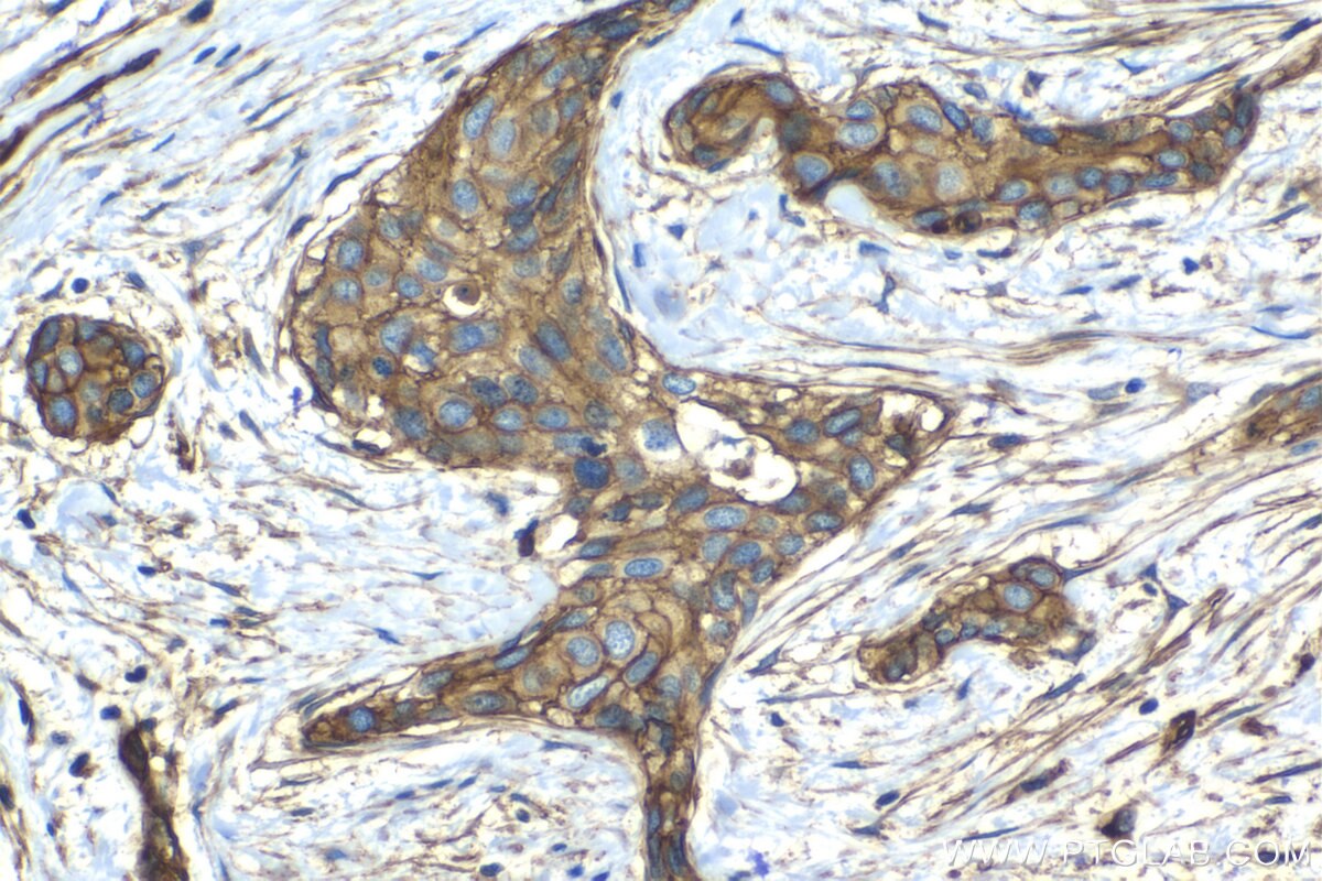 Immunohistochemistry (IHC) staining of human urothelial carcinoma tissue using CD59 Monoclonal antibody (68222-1-Ig)