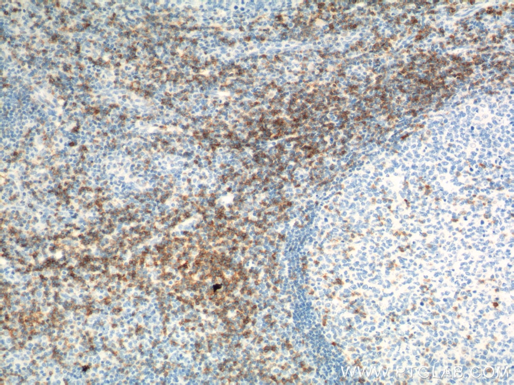 Immunohistochemistry (IHC) staining of human tonsillitis tissue using CD6 Polyclonal antibody (16763-1-AP)