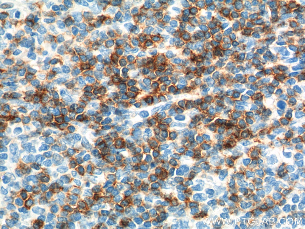 Immunohistochemistry (IHC) staining of human tonsillitis tissue using CD6 Polyclonal antibody (16763-1-AP)