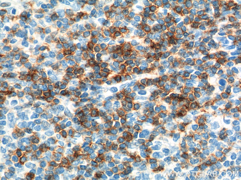 IHC staining of human tonsillitis using 16763-1-AP