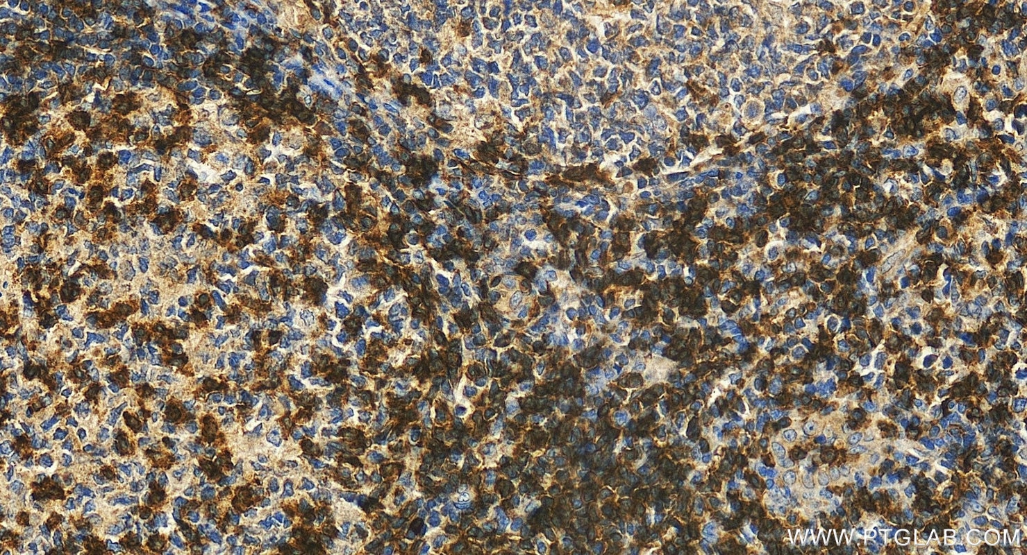 Immunohistochemistry (IHC) staining of human tonsillitis tissue using CD6 Polyclonal antibody (16763-1-AP)
