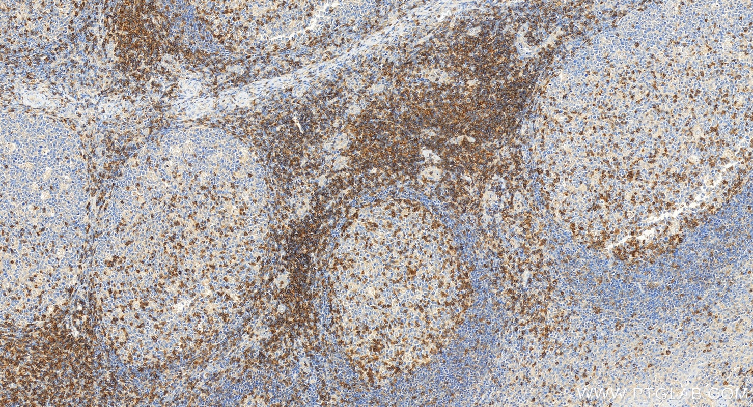 Immunohistochemistry (IHC) staining of human tonsillitis tissue using CD6 Polyclonal antibody (33214-1-AP)