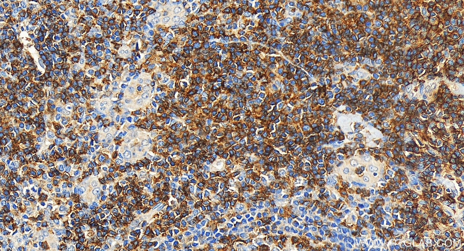 Immunohistochemistry (IHC) staining of human tonsillitis tissue using CD6 Polyclonal antibody (33214-1-AP)