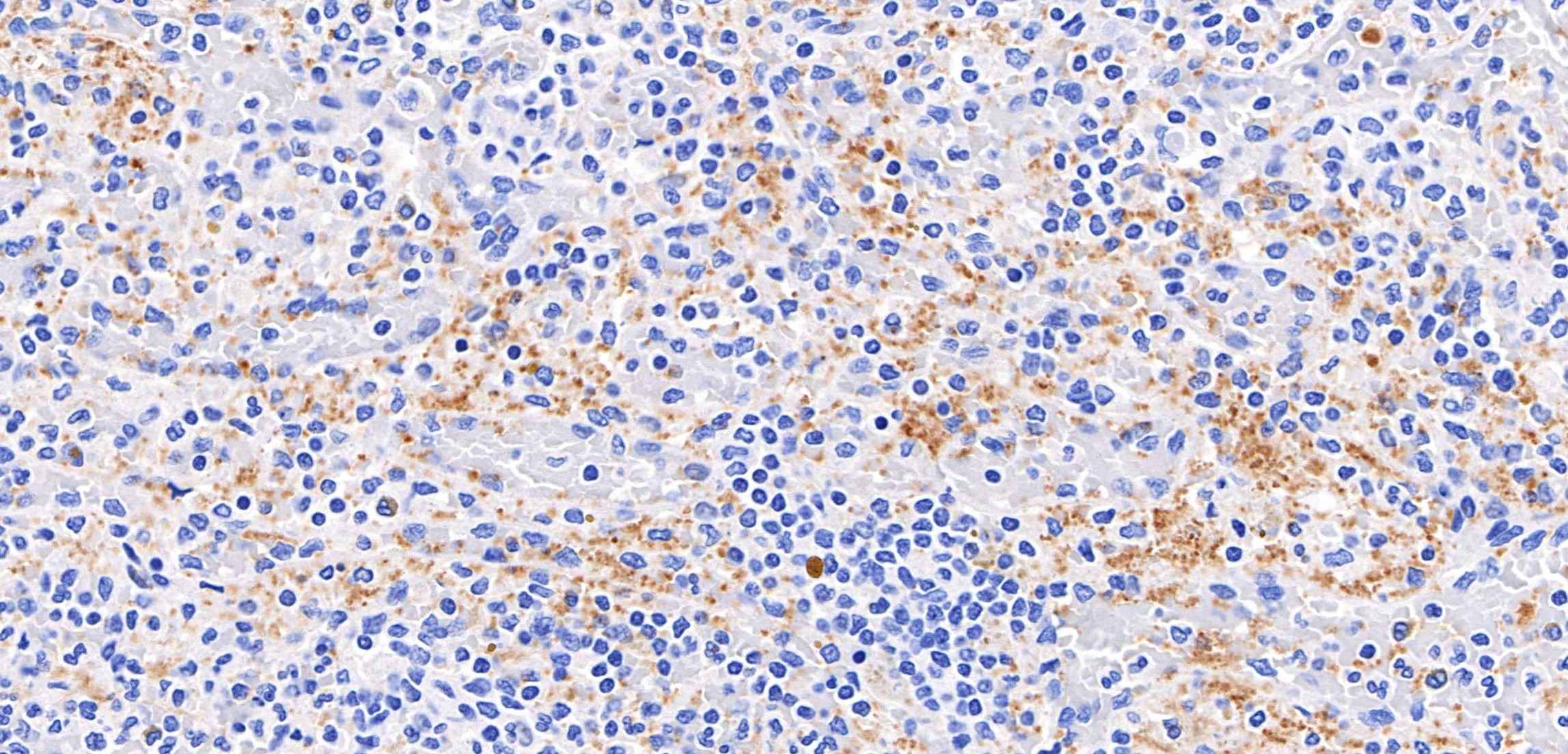 IHC staining of human spleen using 98864-1-RR (same clone as 98864-1-PBS) Immunohistochemistry (IHC) staining of human spleen tissue using Anti-Human CD61 / Integrin beta 3 Rabbit Recombina (98864-1-RR)