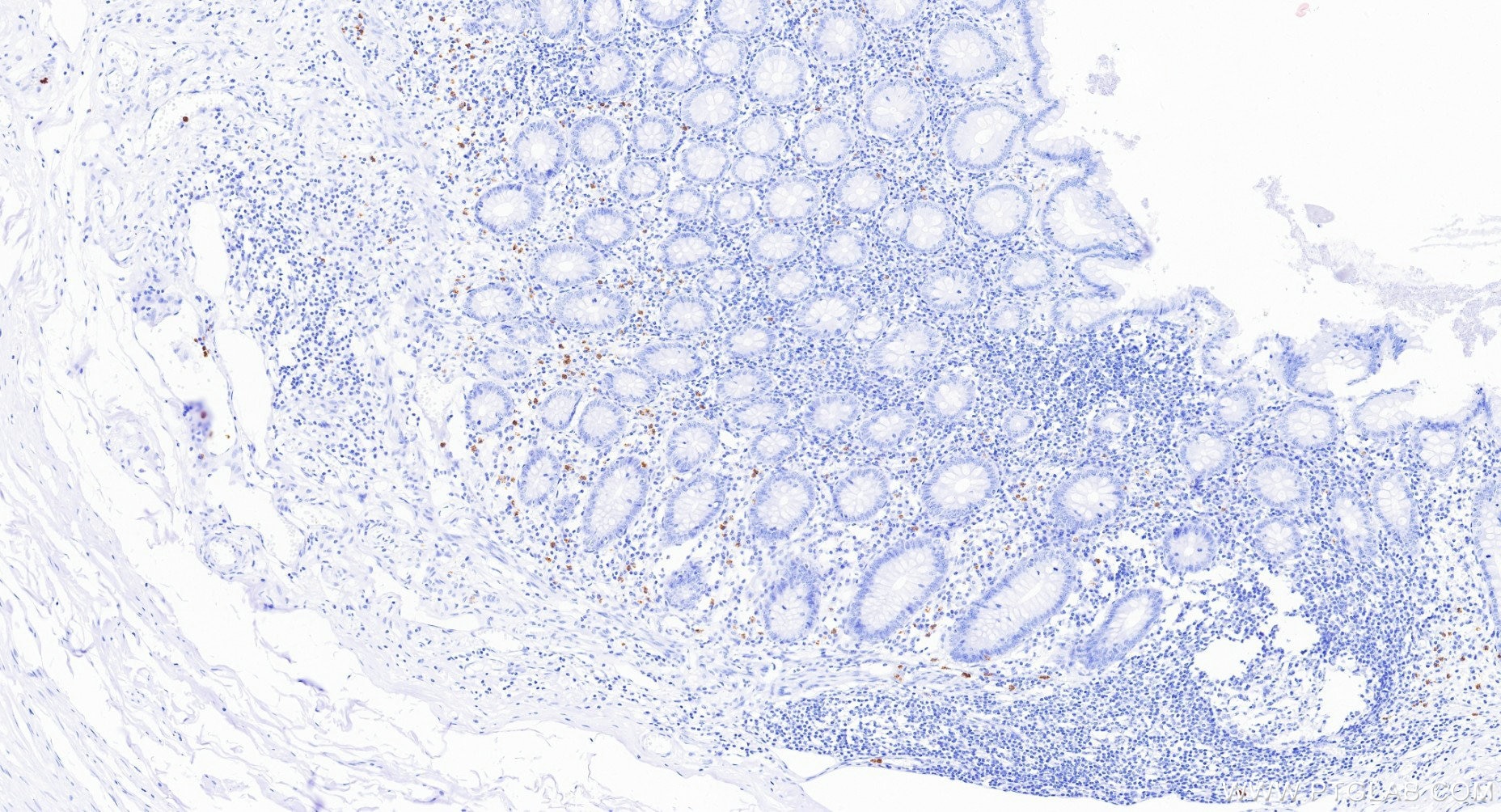 IHC staining of human appendicitis using 85111-6-RR (same clone as 85111-6-PBS) Immunohistochemistry (IHC) staining of human appendicitis tissue using CD62L Recombinant monoclonal antibody (85111-6-RR)