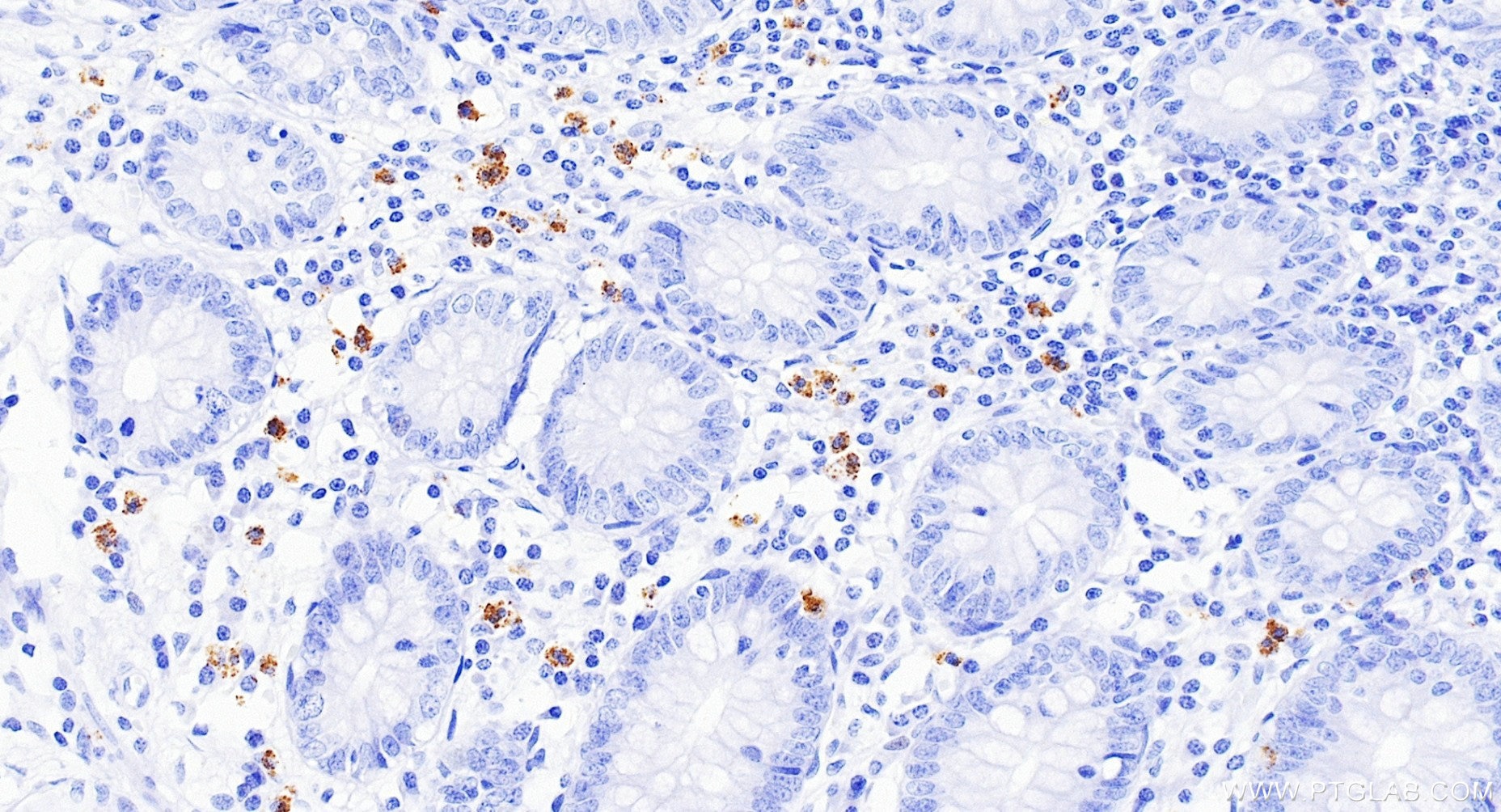 IHC staining of human appendicitis using 85111-6-RR (same clone as 85111-6-PBS) Immunohistochemistry (IHC) staining of human appendicitis tissue using CD62L Recombinant monoclonal antibody (85111-6-RR)