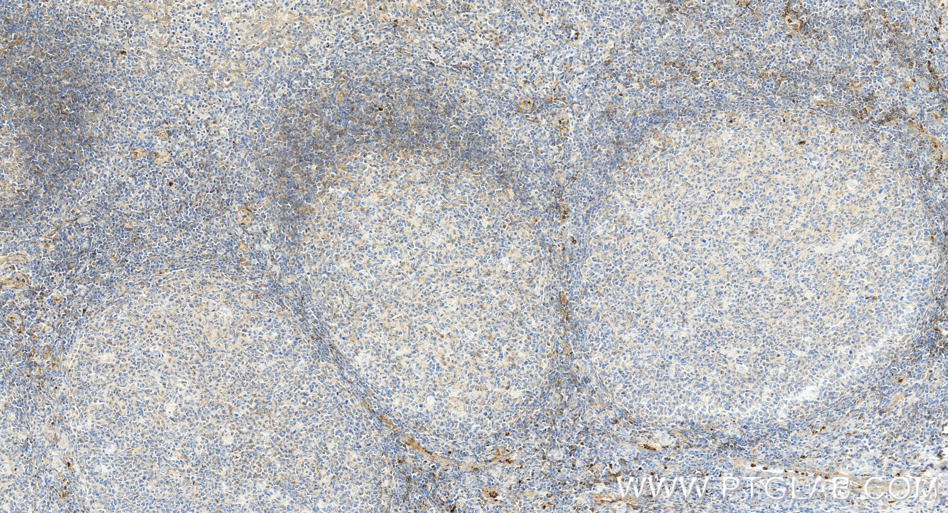 Immunohistochemistry (IHC) staining of human tonsillitis tissue using CD62L Recombinant monoclonal antibody (85111-6-RR)