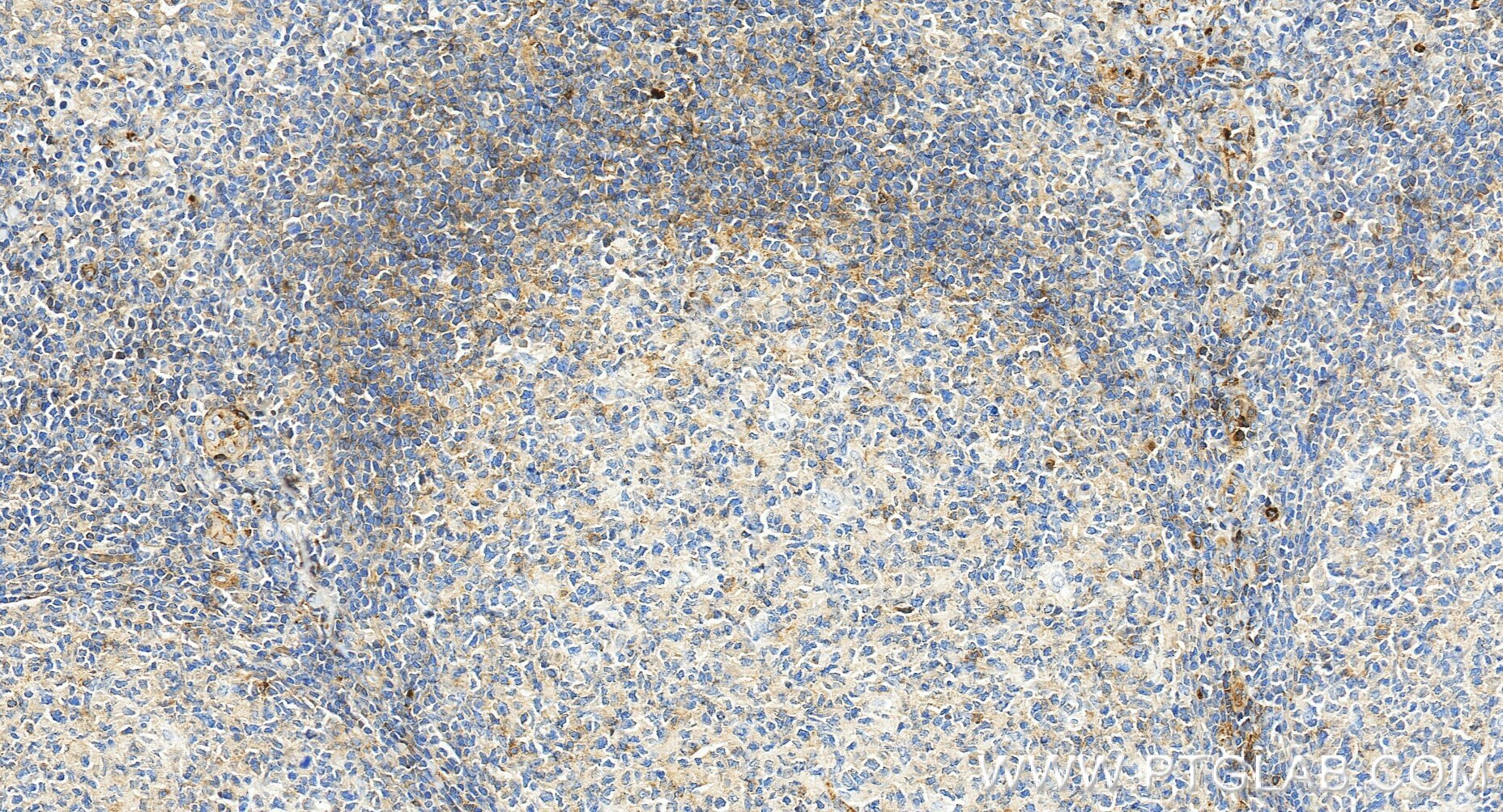 Immunohistochemistry (IHC) staining of human tonsillitis tissue using CD62L Recombinant monoclonal antibody (85111-6-RR)