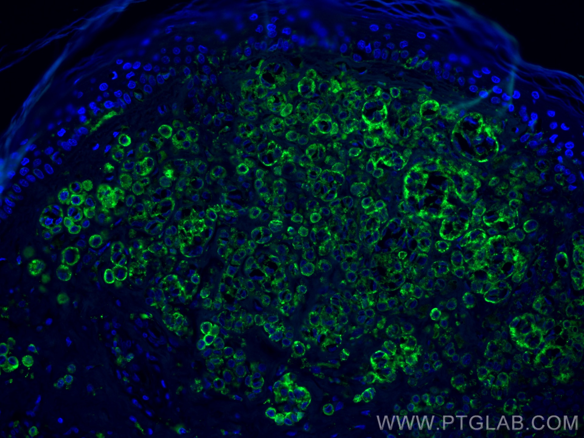 IF Staining of human malignant melanoma using 25682-1-AP