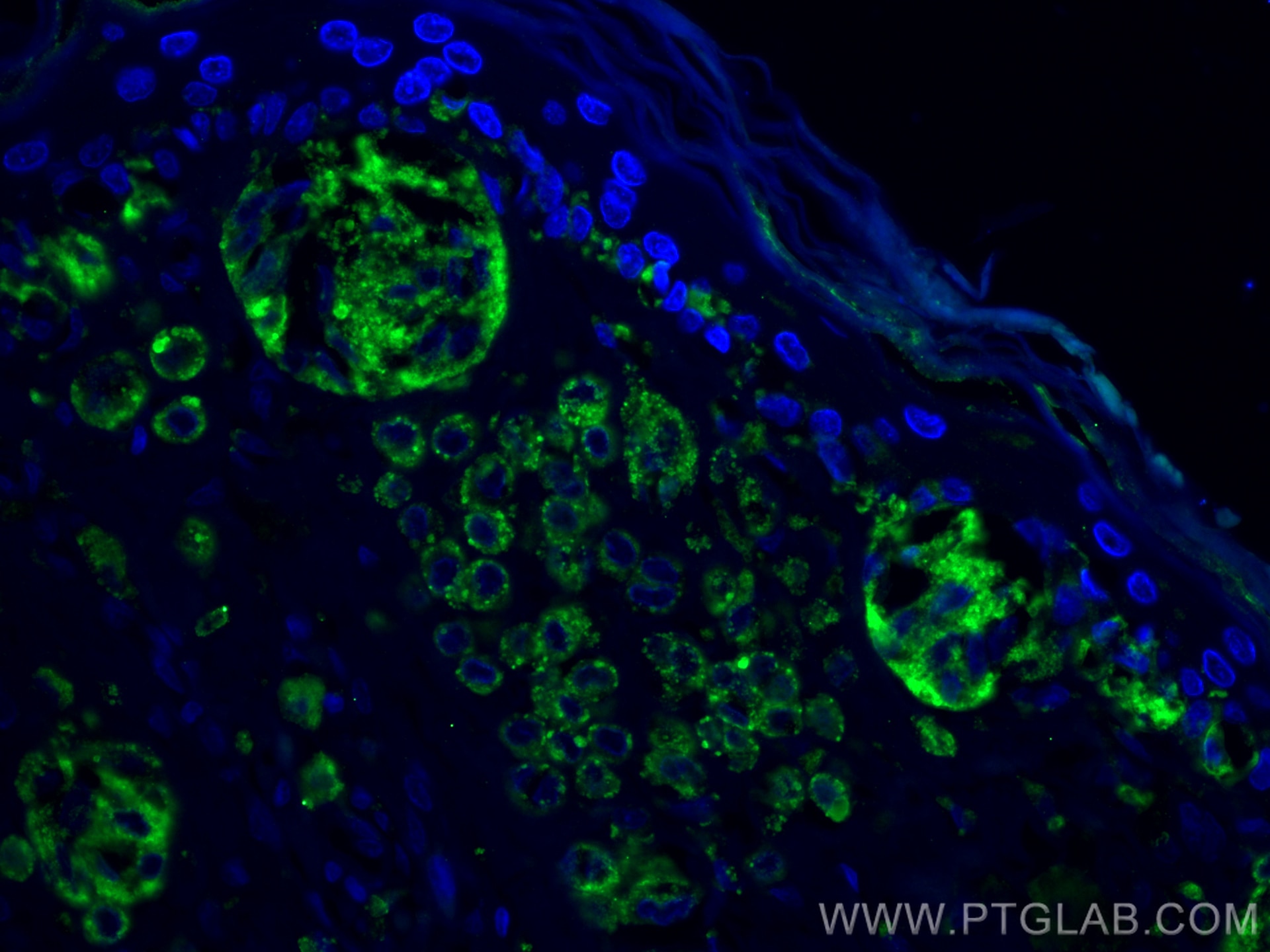 IF Staining of human malignant melanoma using 25682-1-AP