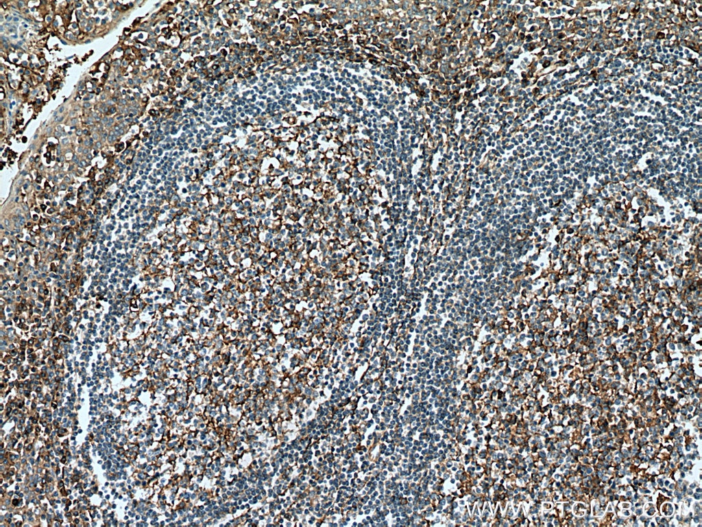 Immunohistochemistry (IHC) staining of human tonsillitis tissue using CD63 Polyclonal antibody (25682-1-AP)