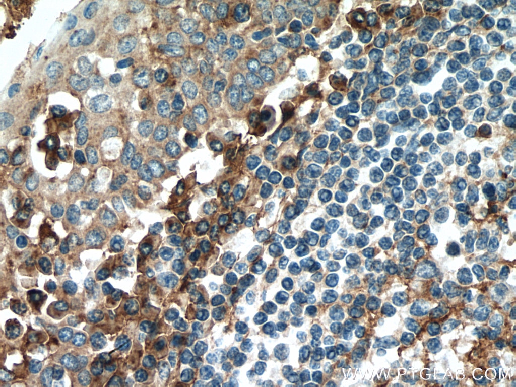 IHC staining of human tonsillitis using 25682-1-AP