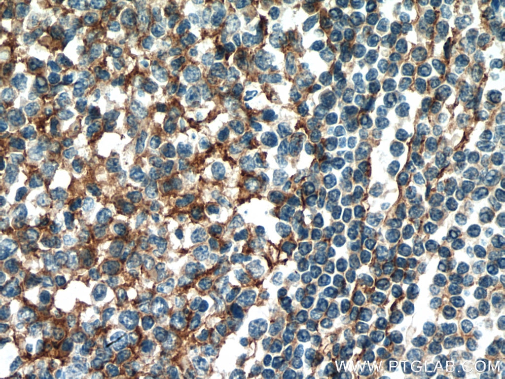 Immunohistochemistry (IHC) staining of human tonsillitis tissue using CD63 Polyclonal antibody (25682-1-AP)