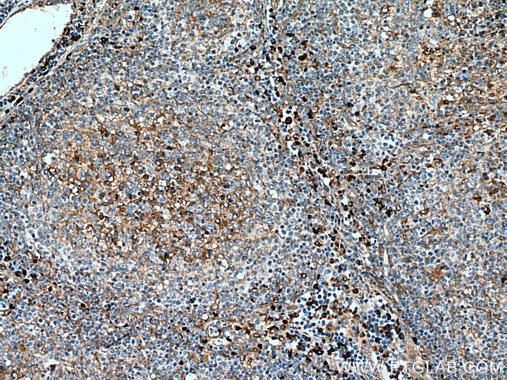 Immunohistochemistry (IHC) staining of human lymphoma tissue using CD63 Polyclonal antibody (25682-1-AP)