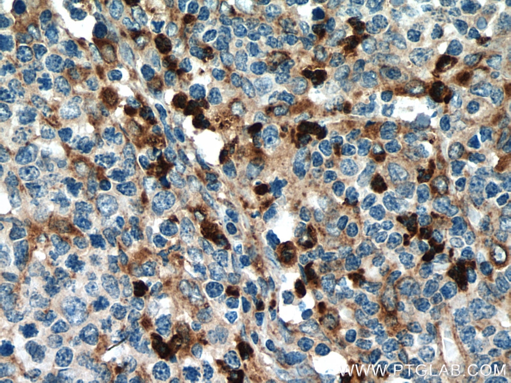 Immunohistochemistry (IHC) staining of human lymphoma tissue using CD63 Polyclonal antibody (25682-1-AP)