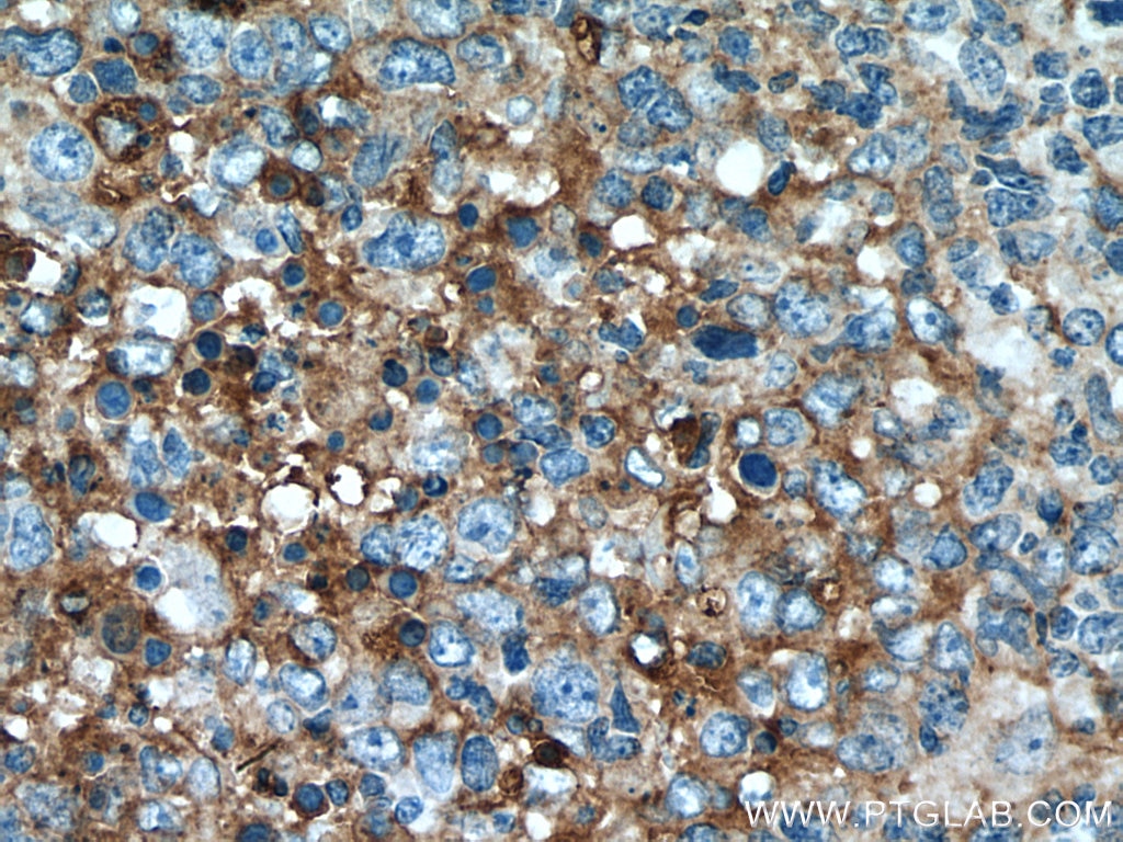 Immunohistochemistry (IHC) staining of human lymphoma tissue using CD63 Polyclonal antibody (25682-1-AP)