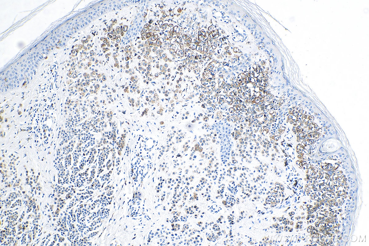 IHC staining of human malignant melanoma using 25682-1-AP