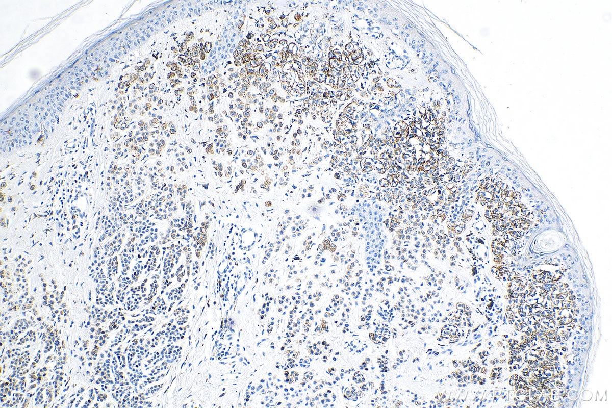 Immunohistochemistry (IHC) staining of human malignant melanoma tissue using CD63 Polyclonal antibody (25682-1-AP)