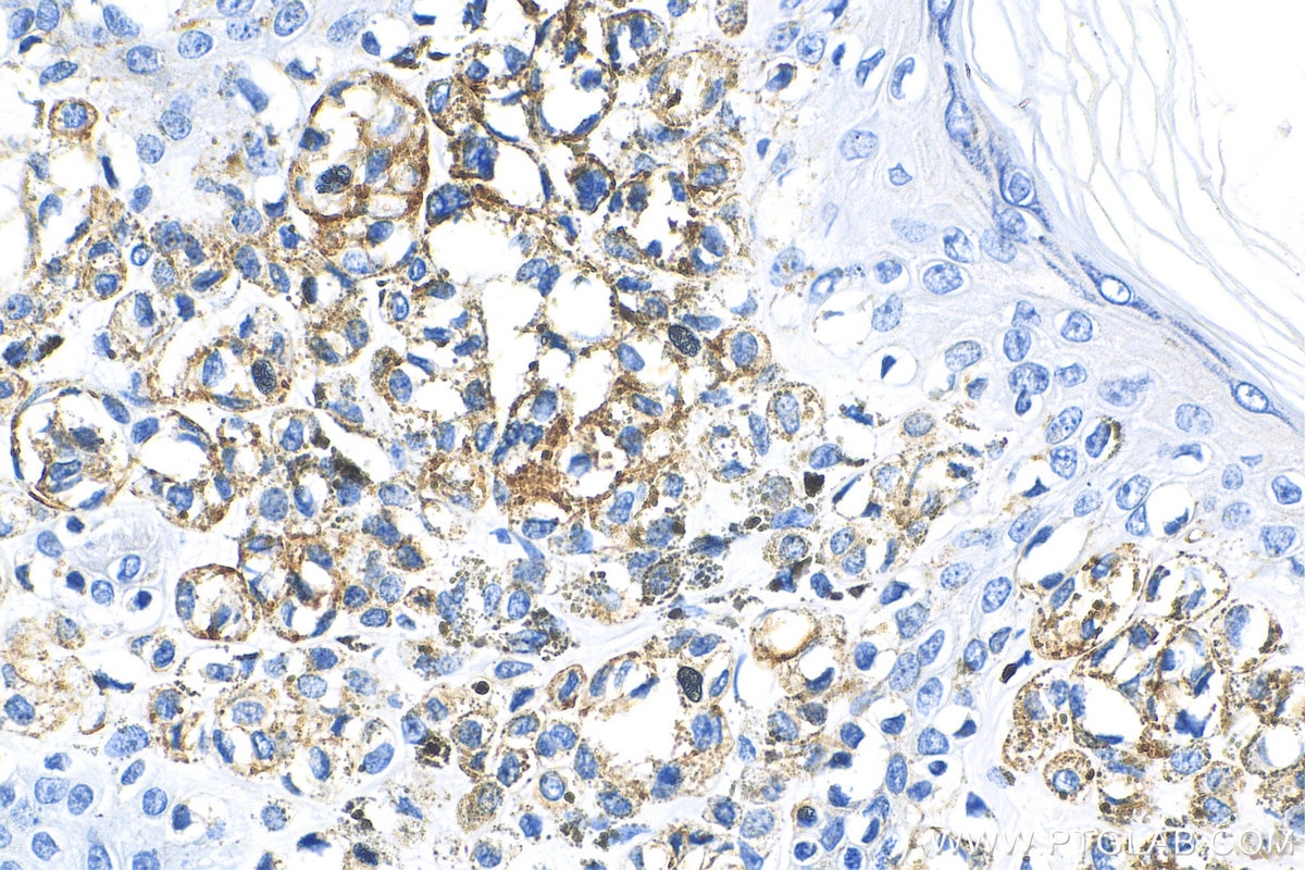 Immunohistochemistry (IHC) staining of human malignant melanoma tissue using CD63 Polyclonal antibody (25682-1-AP)