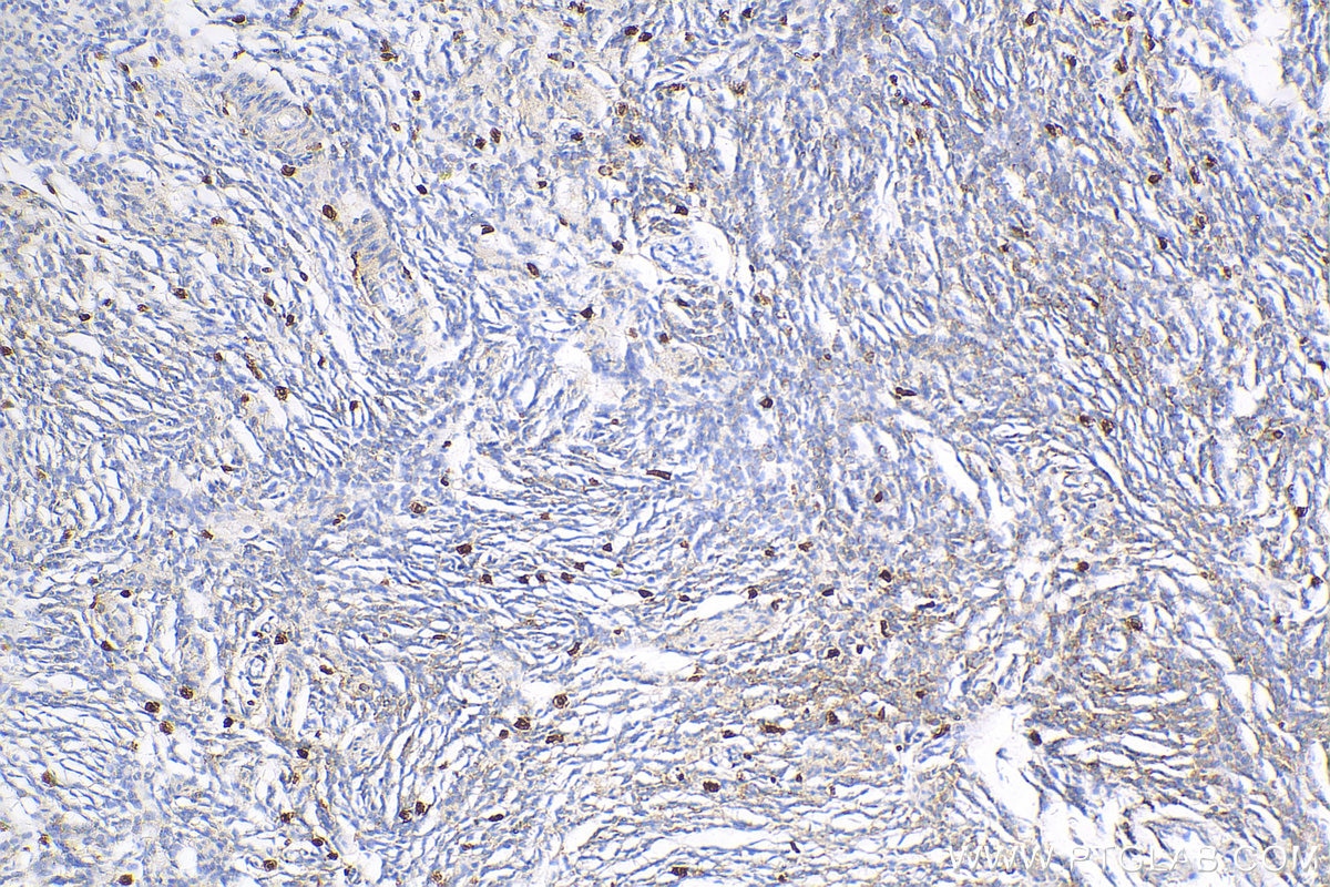 IHC staining of human malignant melanoma using 25682-1-AP