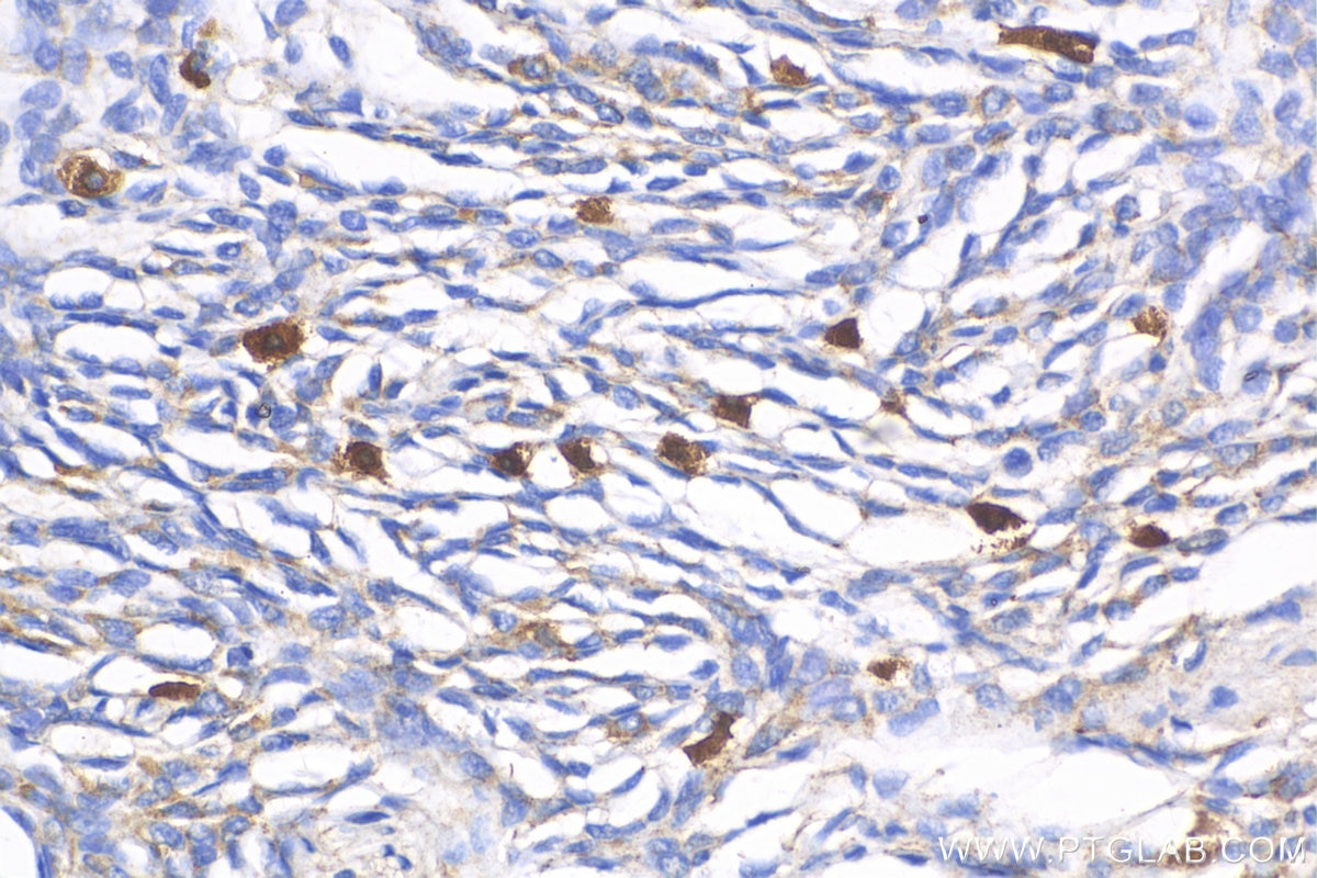 IHC staining of human malignant melanoma using 25682-1-AP