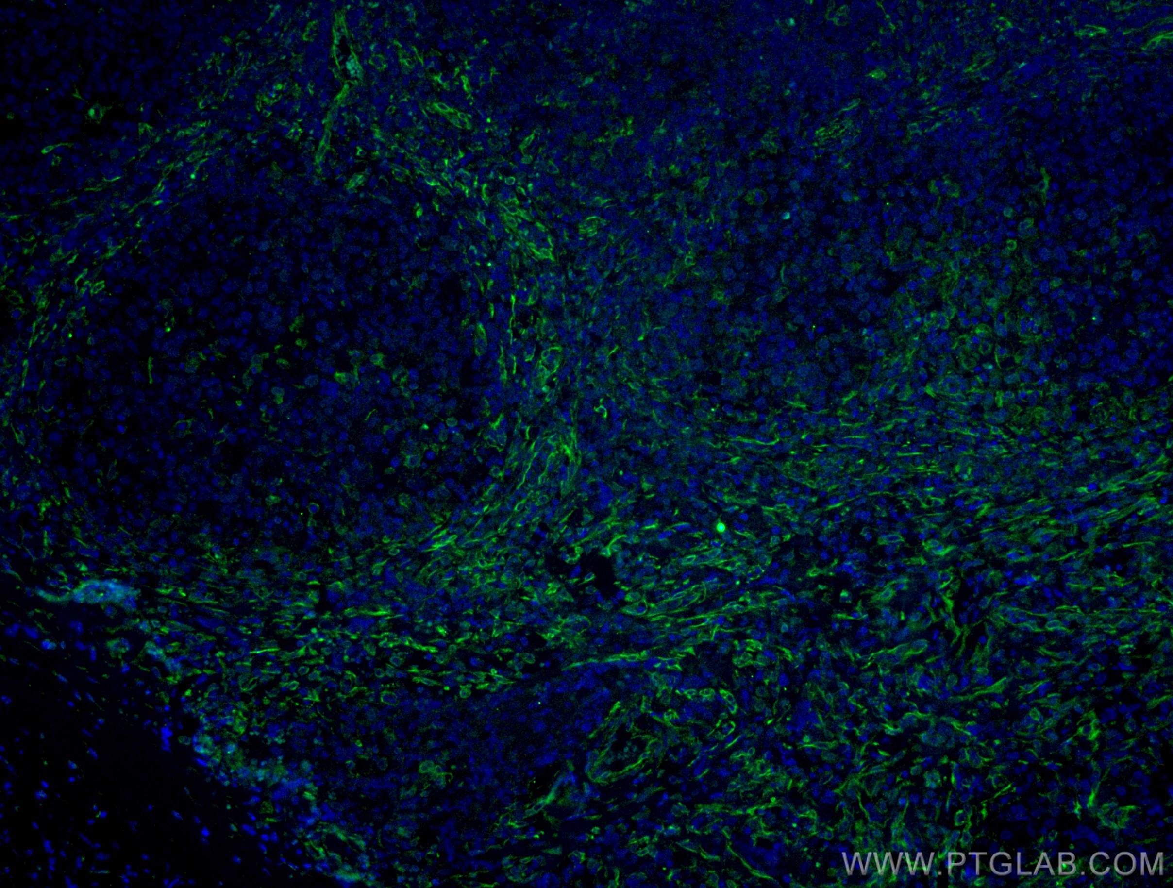 Immunofluorescence (IF) / fluorescent staining of human malignant melanoma tissue using CD63 Monoclonal antibody (67605-1-Ig)