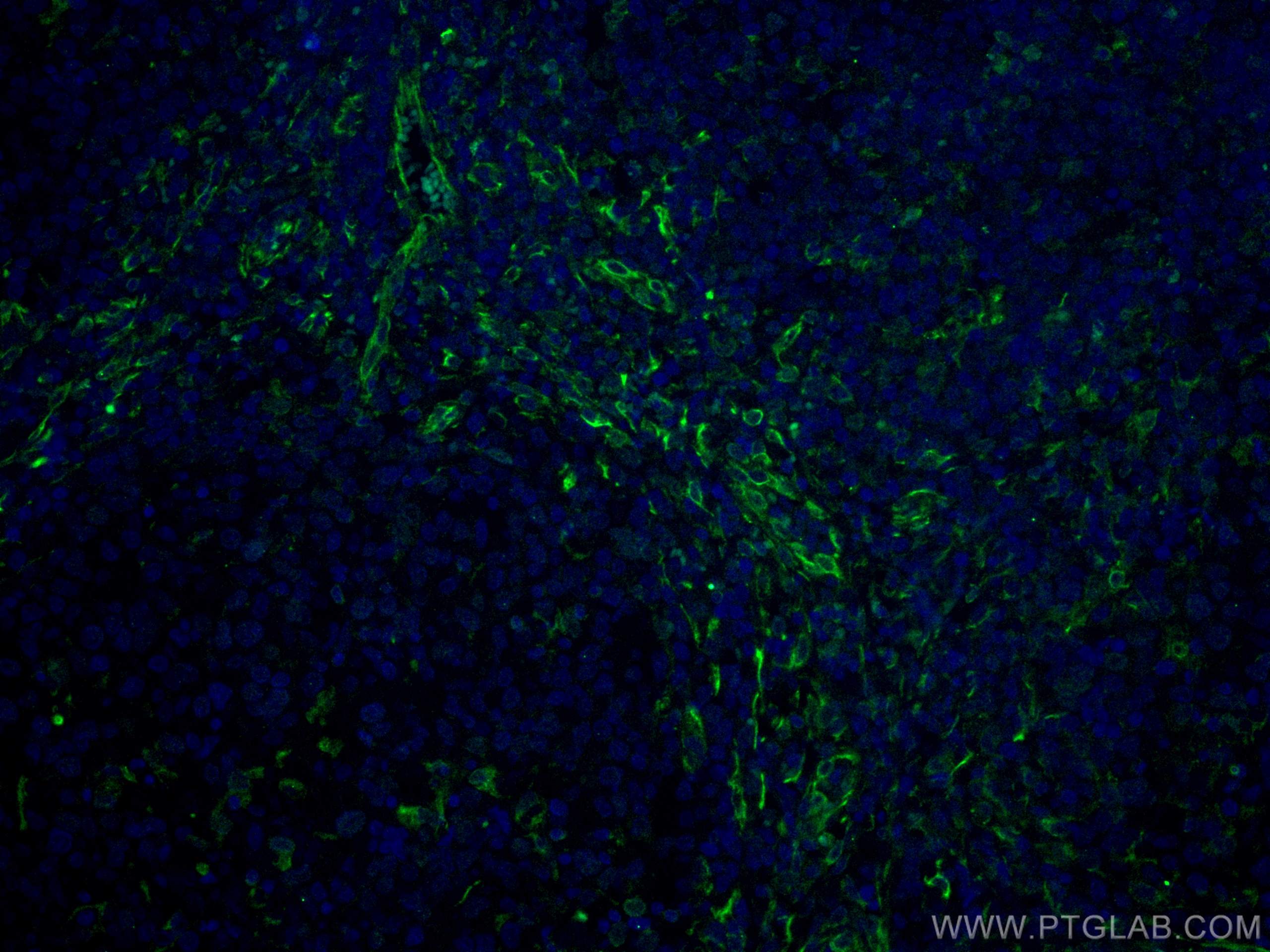Immunofluorescence (IF) / fluorescent staining of human malignant melanoma tissue using CD63 Monoclonal antibody (67605-1-Ig)
