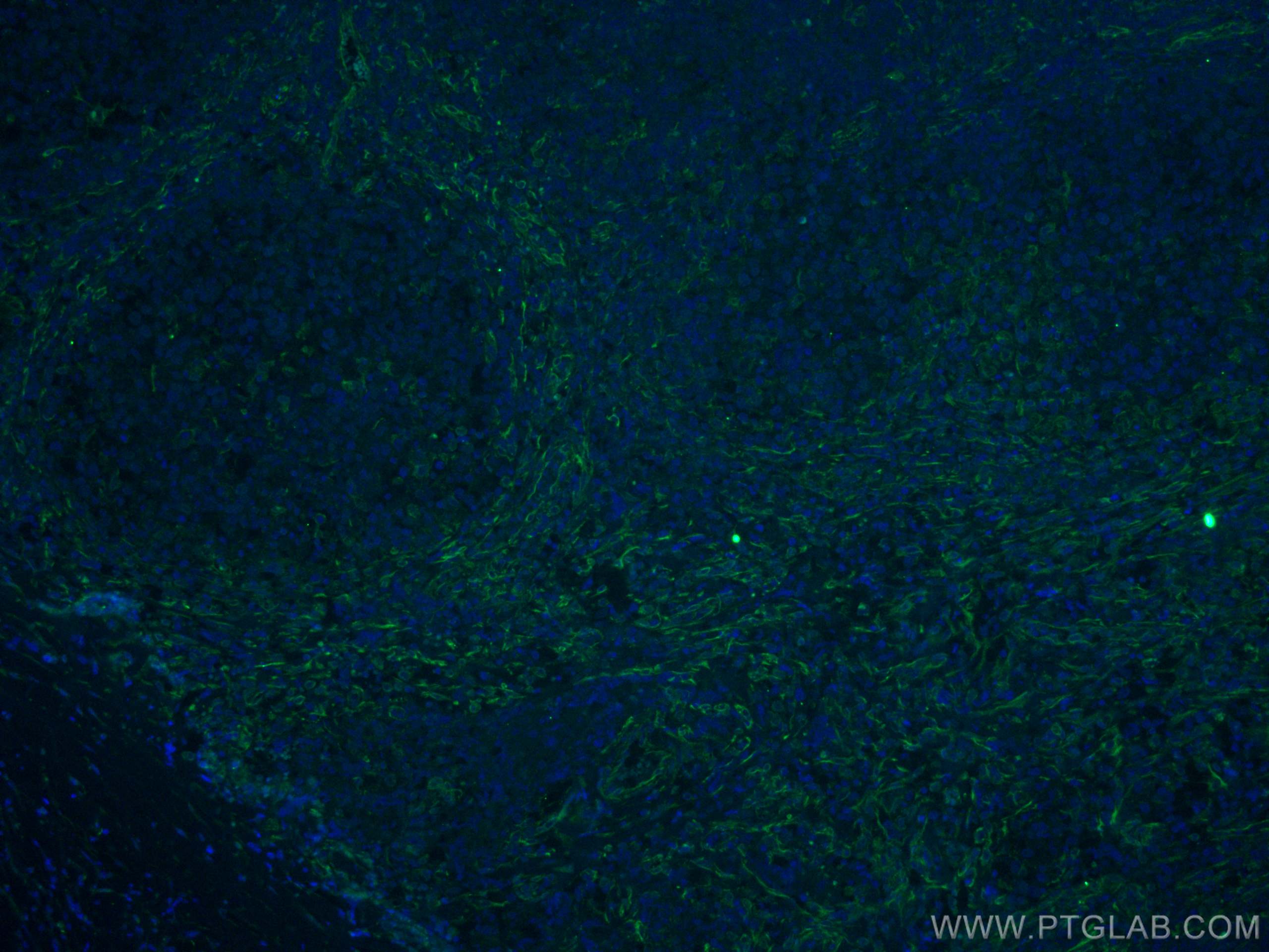 Immunofluorescence (IF) / fluorescent staining of human lymphoma tissue using CD63 Monoclonal antibody (67605-1-Ig)