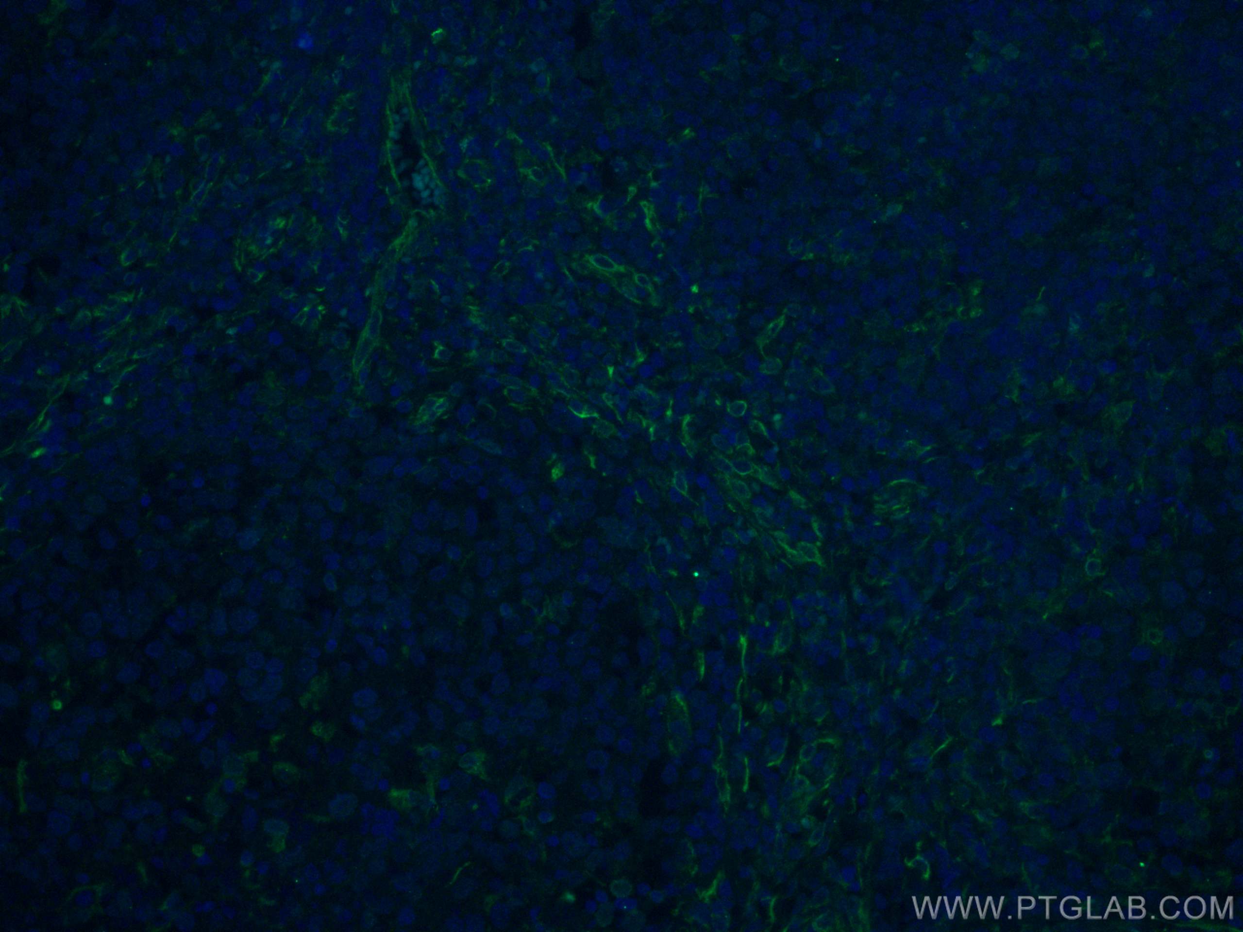 Immunofluorescence (IF) / fluorescent staining of human lymphoma tissue using CD63 Monoclonal antibody (67605-1-Ig)