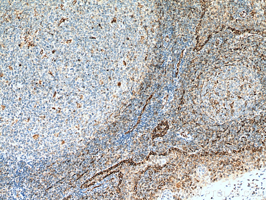 Immunohistochemistry (IHC) staining of human tonsillitis tissue using CD63 Monoclonal antibody (67605-1-Ig)