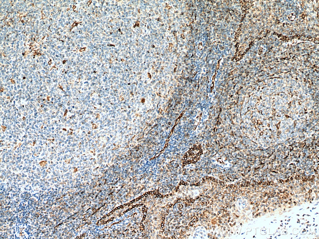 IHC staining of human tonsillitis using 67605-1-Ig