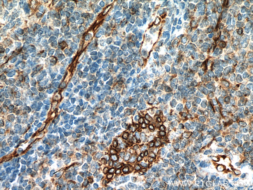 IHC staining of human tonsillitis using 67605-1-Ig