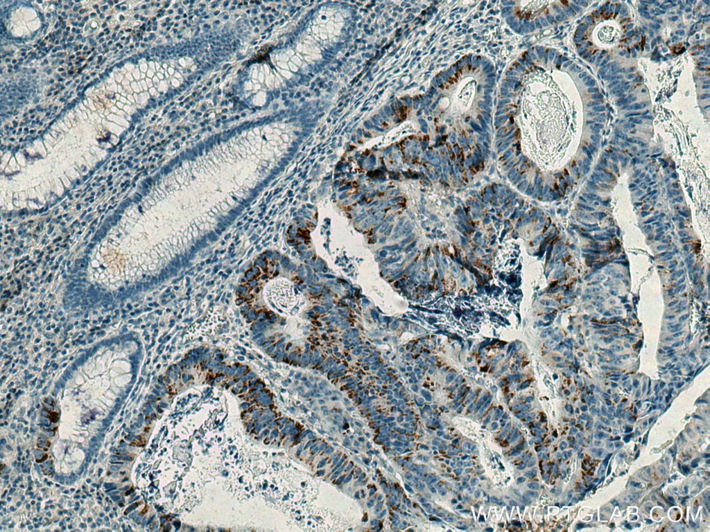Immunohistochemistry (IHC) staining of human colon cancer tissue using CD63 Monoclonal antibody (67605-1-Ig)