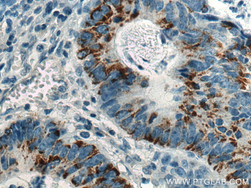 Immunohistochemistry (IHC) staining of human colon cancer tissue using CD63 Monoclonal antibody (67605-1-Ig)