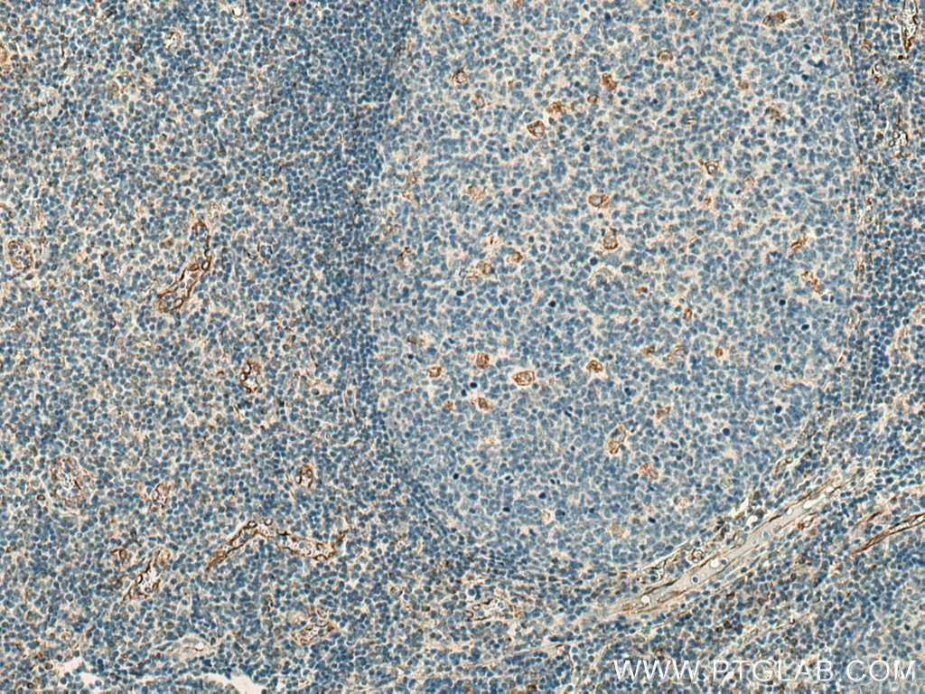 IHC staining of human tonsillitis using 67605-1-Ig