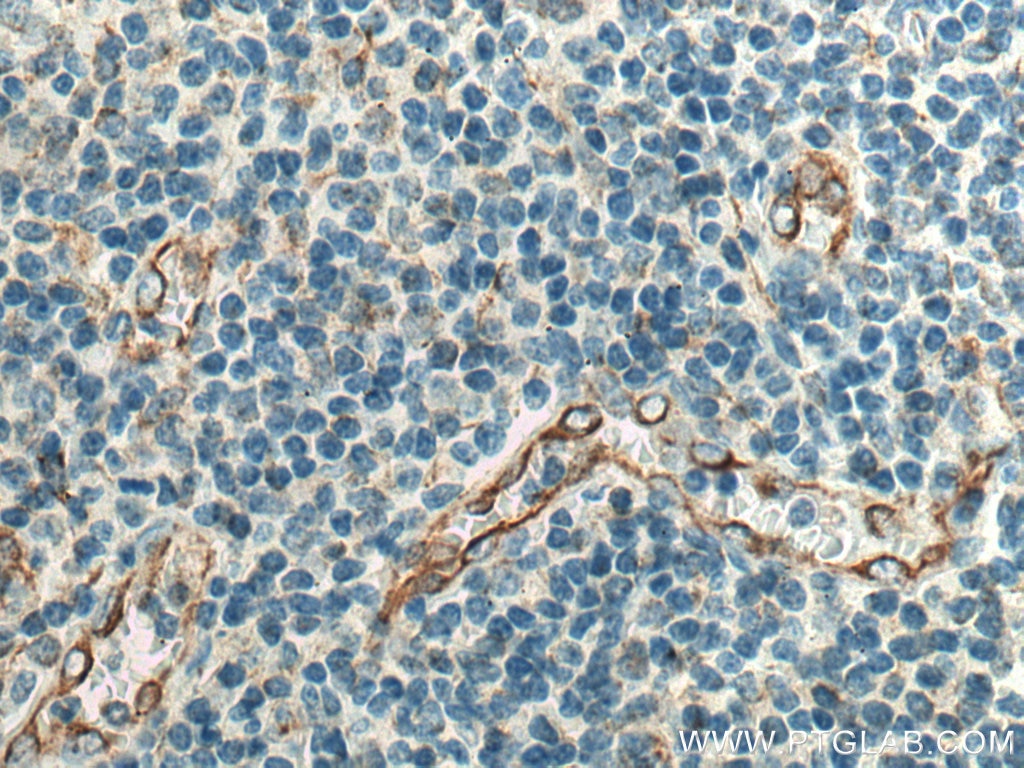 Immunohistochemistry (IHC) staining of human tonsillitis tissue using CD63 Monoclonal antibody (67605-1-Ig)