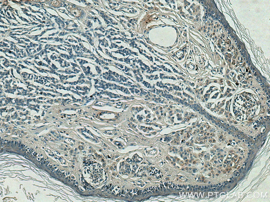 Immunohistochemistry (IHC) staining of human malignant melanoma tissue using CD63 Monoclonal antibody (67605-1-Ig)