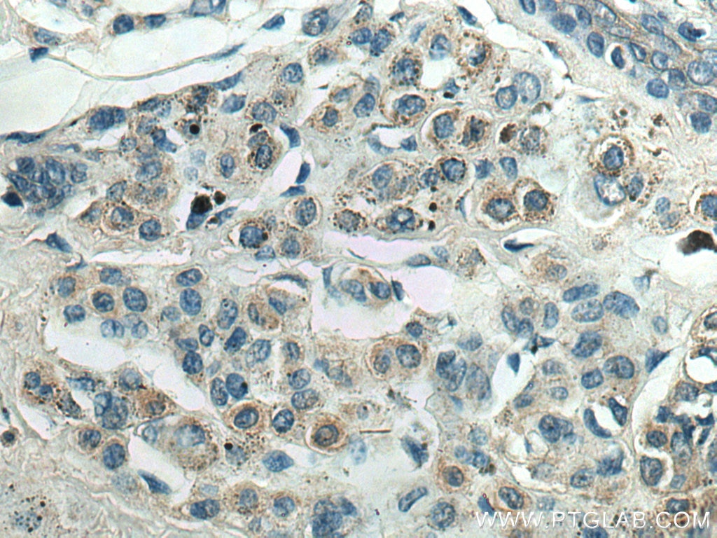 IHC staining of human malignant melanoma using 67605-1-Ig