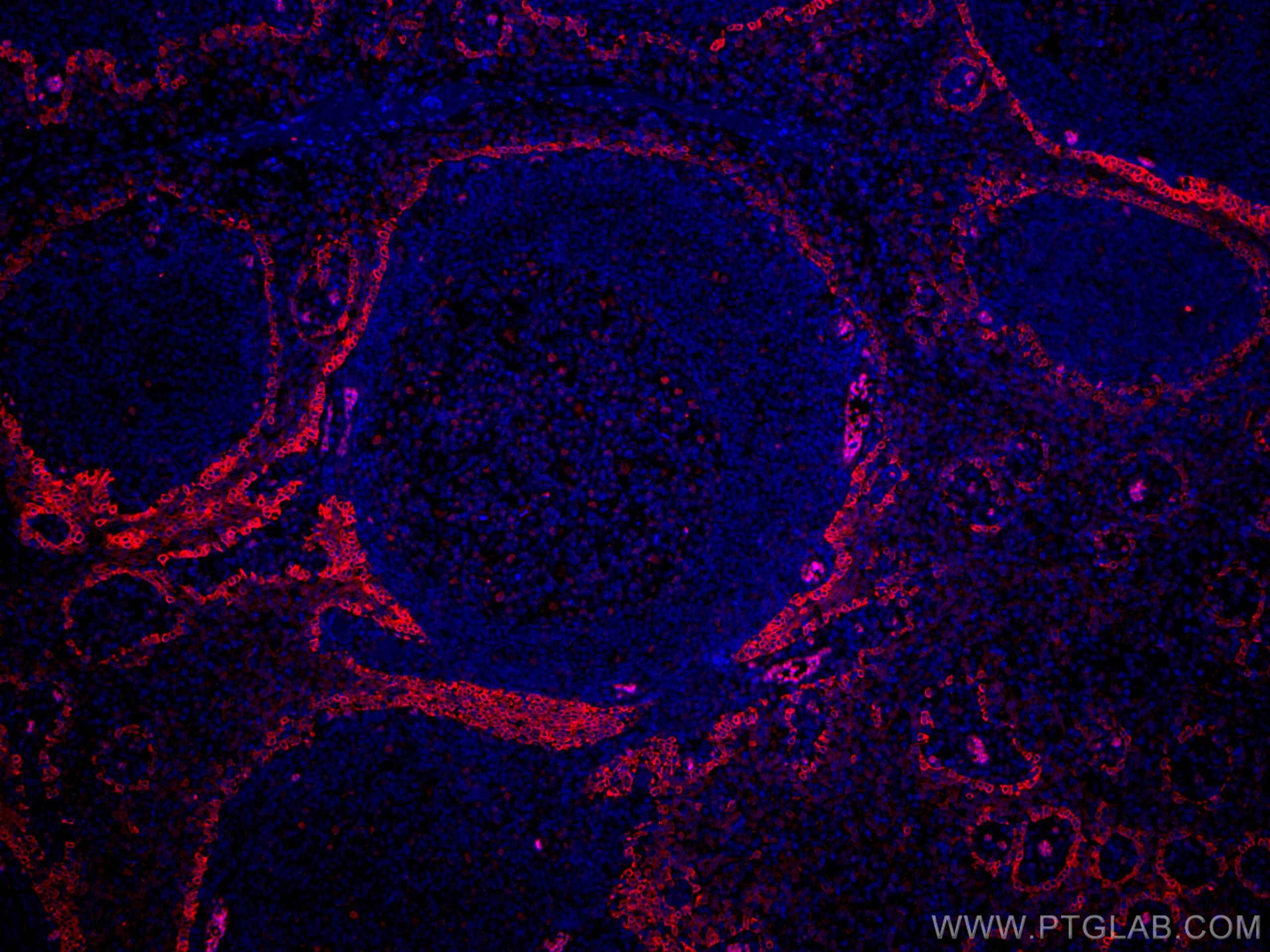 Immunofluorescence (IF) / fluorescent staining of human tonsillitis tissue using CoraLite®594-conjugated CD63 Monoclonal antibody (CL594-67605)