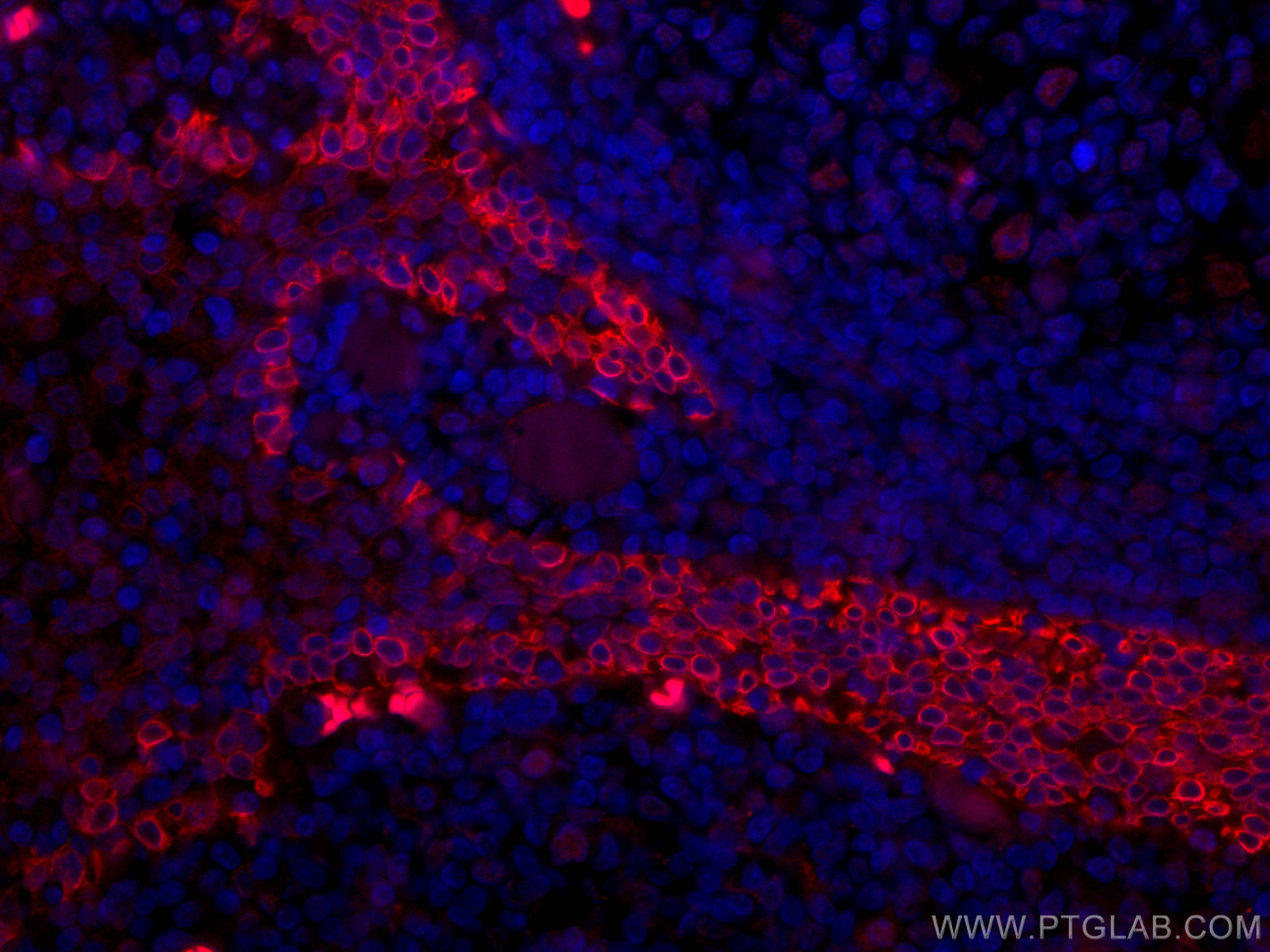 Immunofluorescence (IF) / fluorescent staining of human tonsillitis tissue using CoraLite®594-conjugated CD63 Monoclonal antibody (CL594-67605)