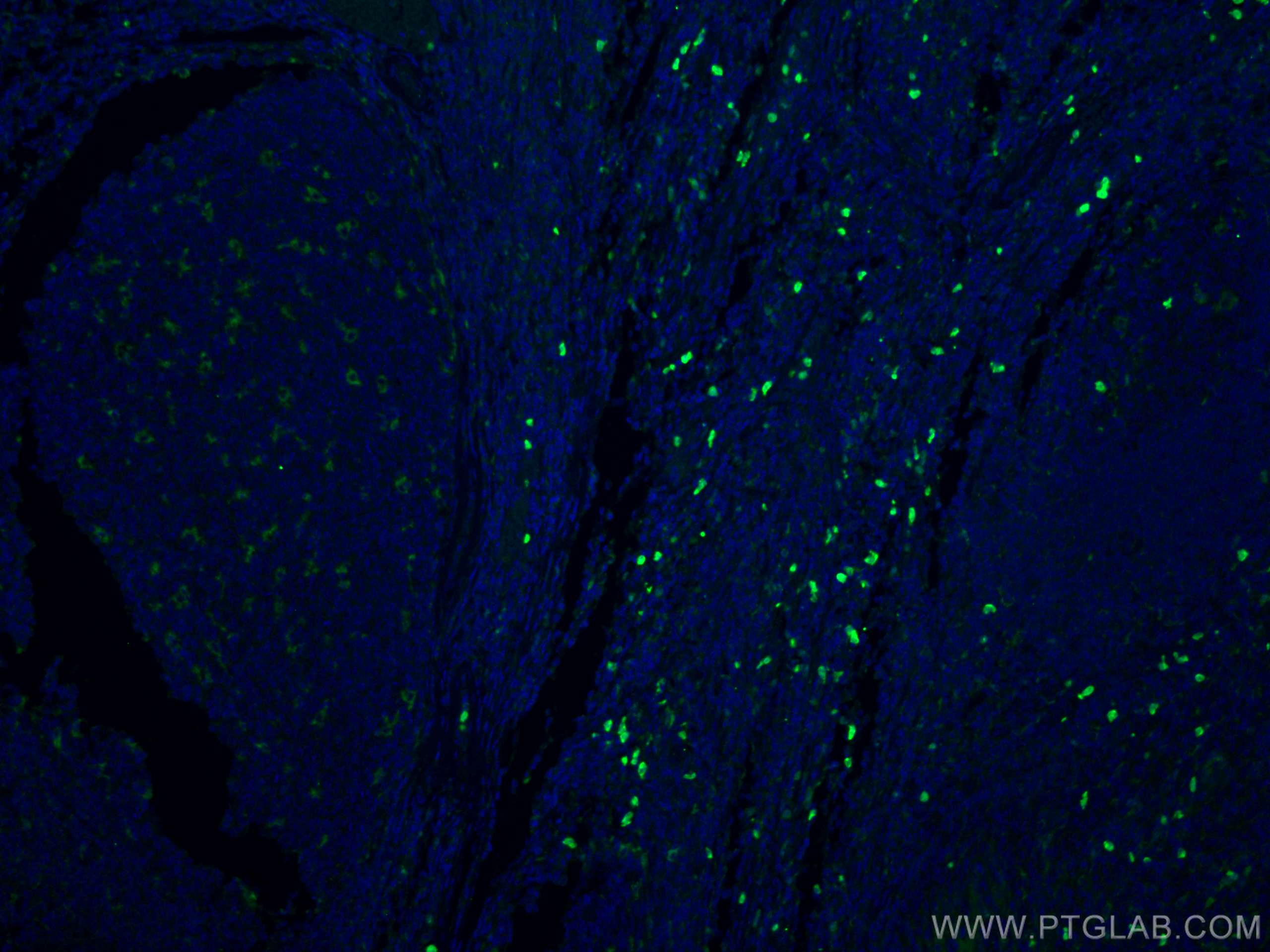 IF Staining of human tonsillitis using 25747-1-AP