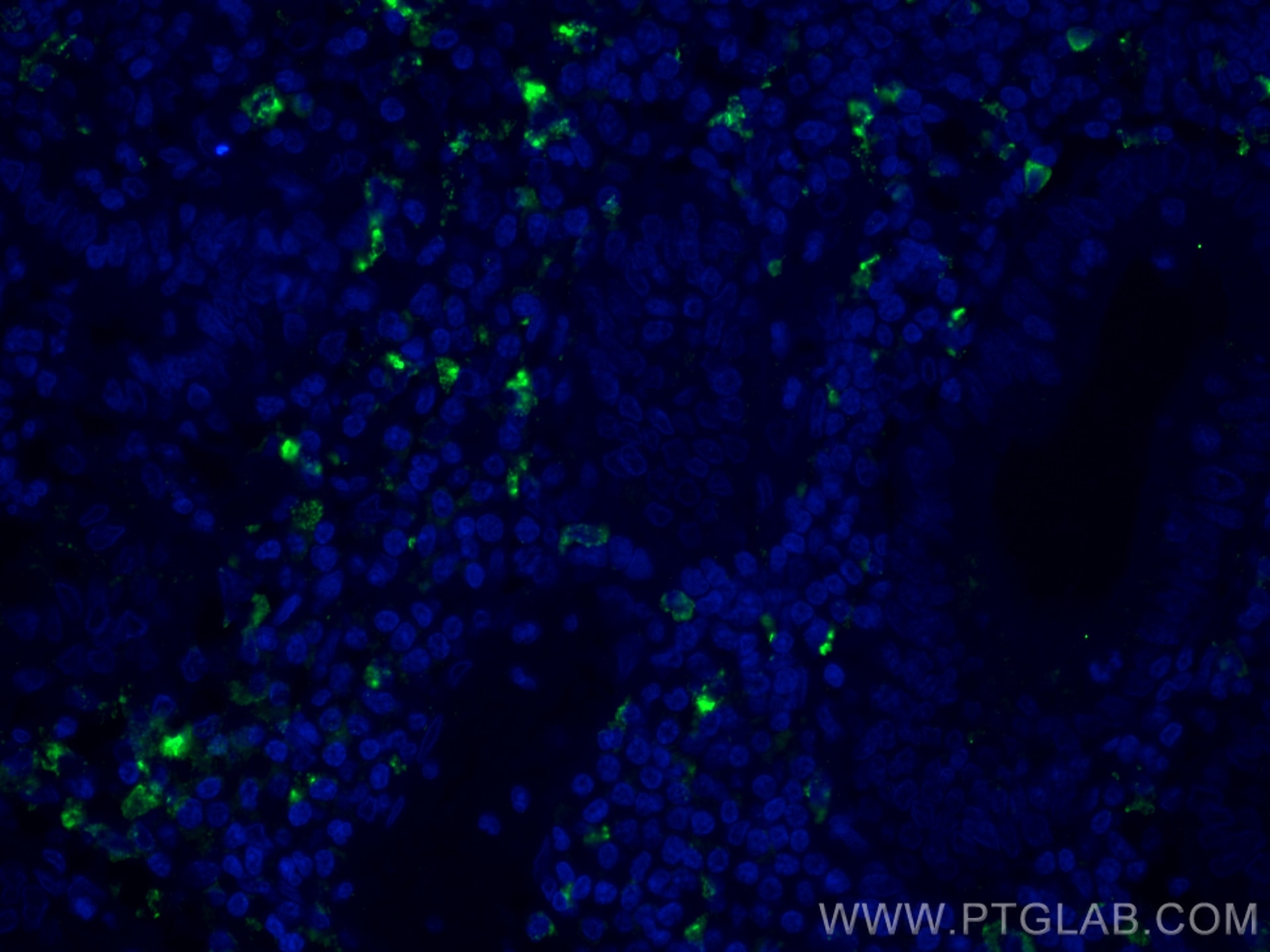 Immunofluorescence (IF) / fluorescent staining of human appendicitis tissue using CD68 Polyclonal antibody (25747-1-AP)
