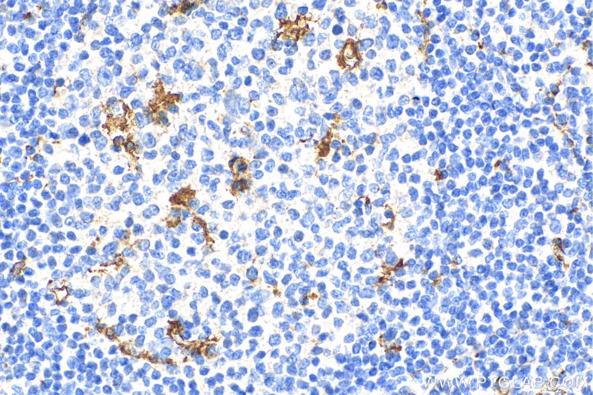 Immunohistochemistry (IHC) staining of human tonsillitis tissue using CD68 Polyclonal antibody (25747-1-AP)